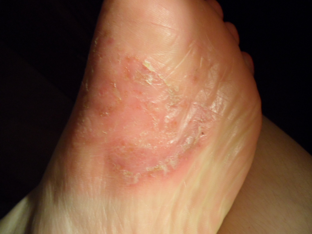 因此很多的脚部湿疹患者就比较想要知道如何治能治好?下面我